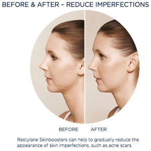 REJEON Skin Booster Anti aging Skin Care Whiten Skin For Face Neck